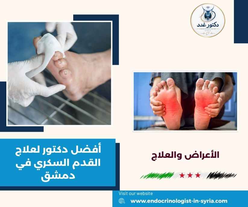 أفضل دكتور لعلاج القدم السكري في دمشق